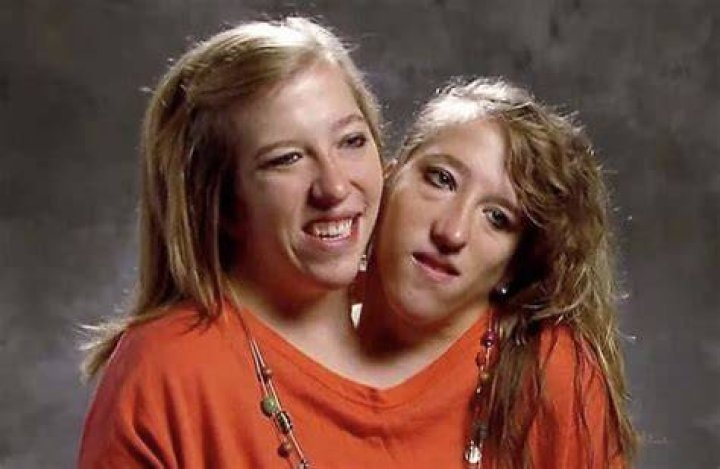 Conjoined Twins Abby and Brittany Hensel Now Work as Teachers