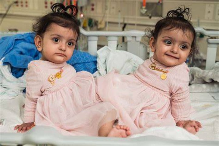 Conjoined twins separated, undergo surgery as individuals FOX31 Denver