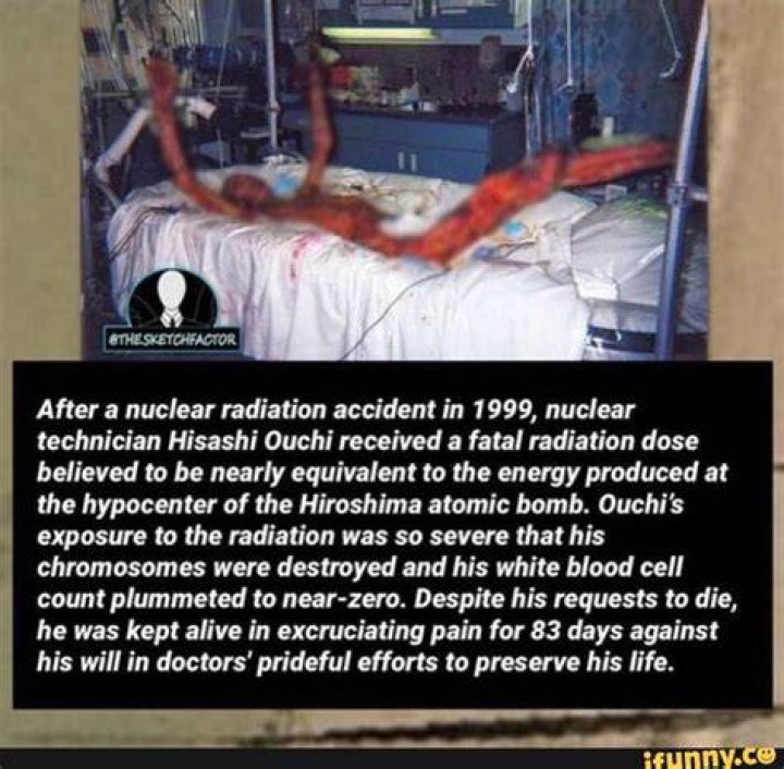 Hisashi Ouchi's 1999 Accident: A Tragic Tale Of Radiation Exposure