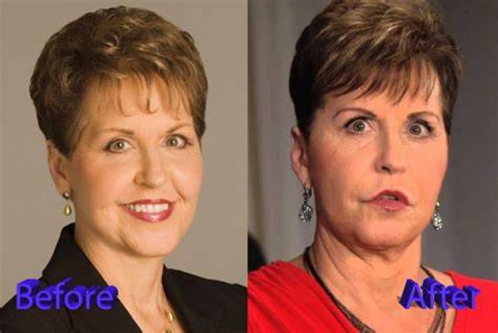 Joyce Meyer Plastic Surgery: Surprising Revelations Unveiled