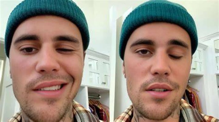 Justin Bieber Qué es el síndrome de Ramsay Hunt, la condición que