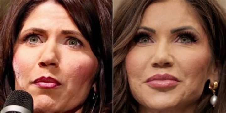 Kristi Noem Plastic Surgery: A Complete Guide To Before And After Results