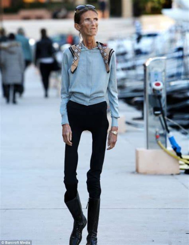 Meet The Thinnest Person In The World: An Extraordinary Tale Of Survival