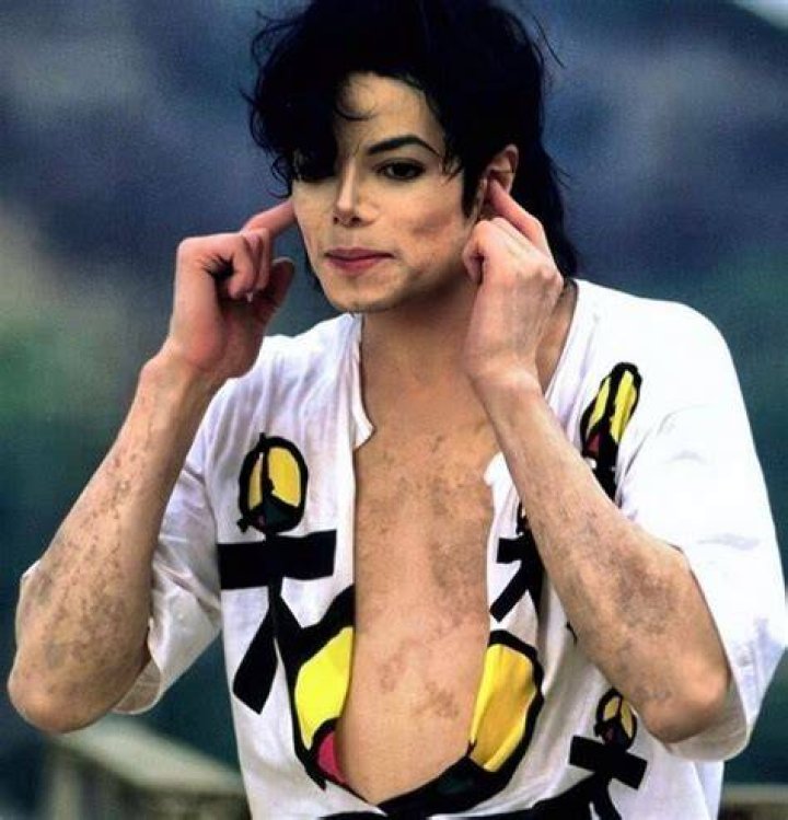 Michael Jackson&rsquo;s Skin Condition
