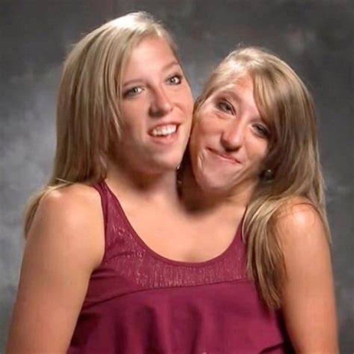 Miracle Of Life: Conjoined Twins Abby And Brittany Hensel Expecting Child