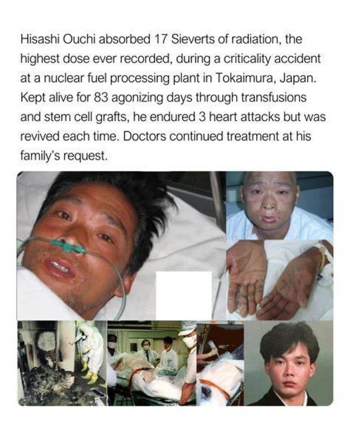 Mysterious 83 Days: Disturbing Photos Of Hisashi Ouchi's Tragic Accident
