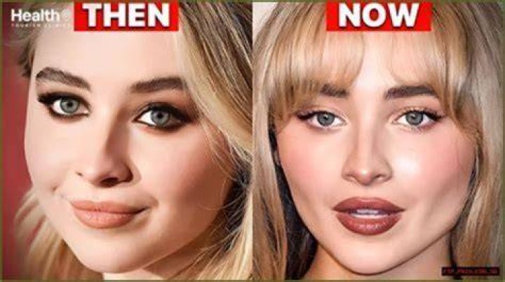 Plastic Surgery Rumors: The Truth About Sabrina Carpenter's Alleged Procedures