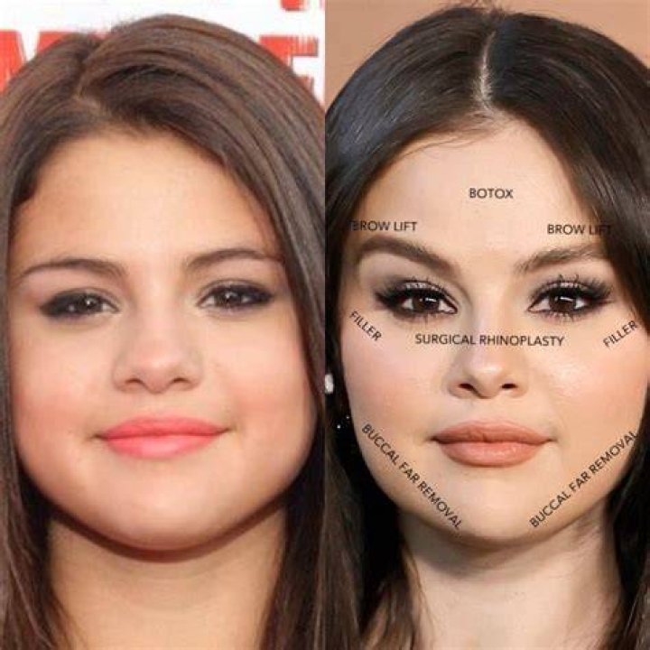 Selena Gomez's Transformation: Before And After Surgery