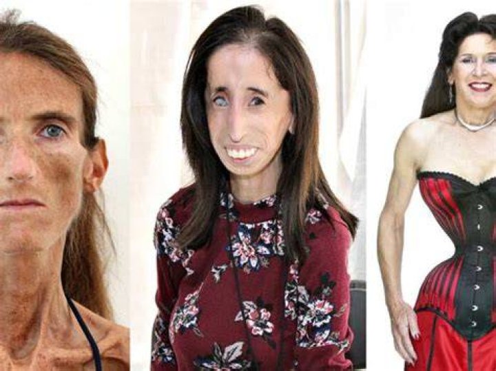 Skinniest Person Meet 10 World's Thinnest People Alive 2024 The
