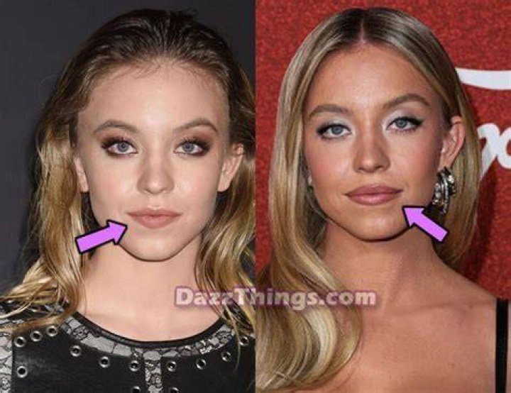 Sydney Sweeney Plastic Surgery: What You Need To Know
