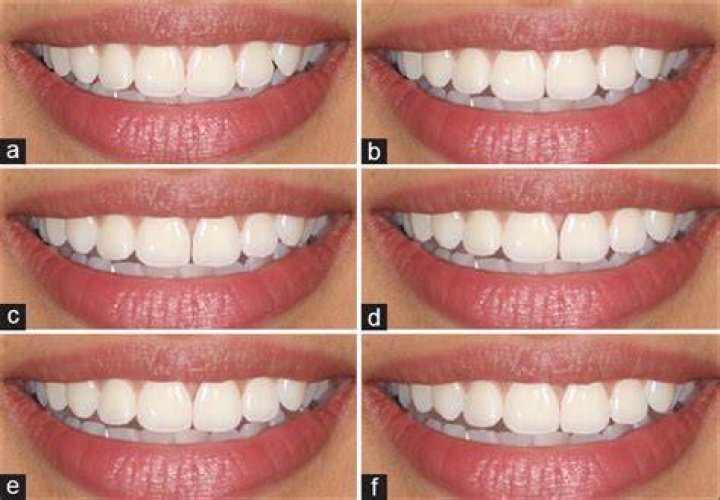 Teeth midline shift News Dentagama