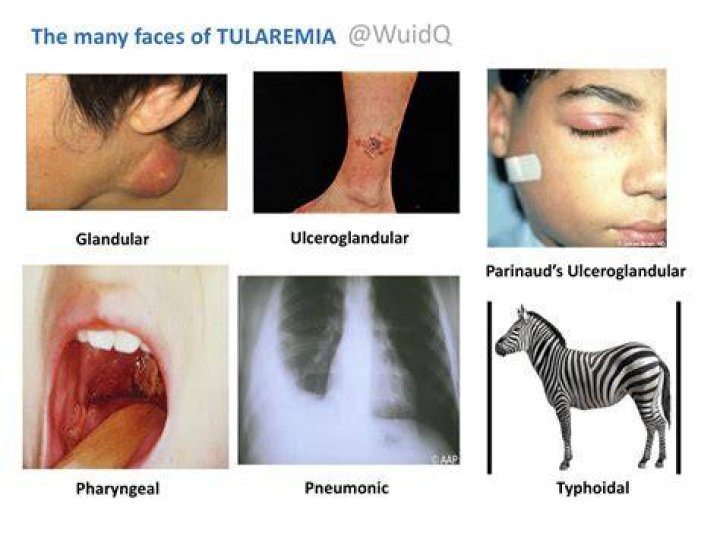 The Many Faces of Tularemia &bull; Glandular &bull; Ulceroglandular GrepMed