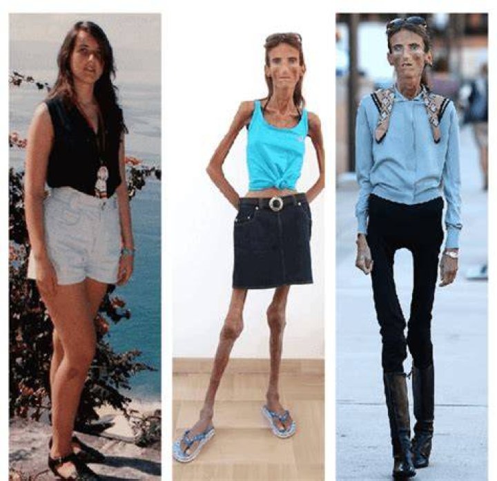 The Shocking Weight Of The World's Skinniest Person: A Medical Marvel