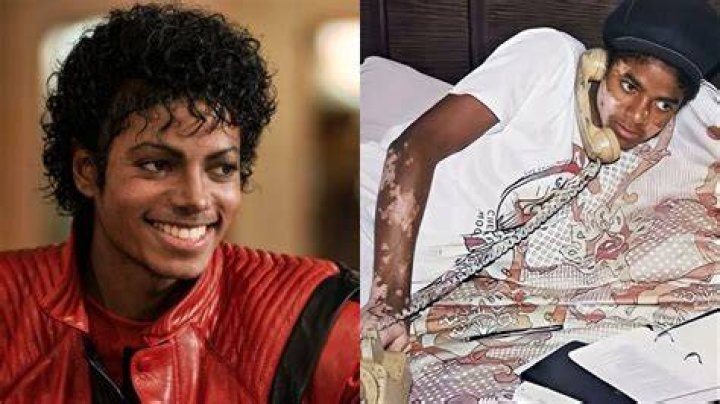 The Unraveling Truth Behind Michael Jackson's Mysterious Skin Condition