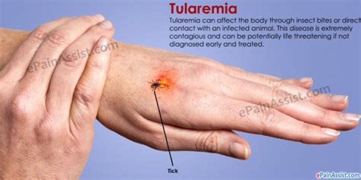 Tularemia, a potentially serious and lifethreatening disease