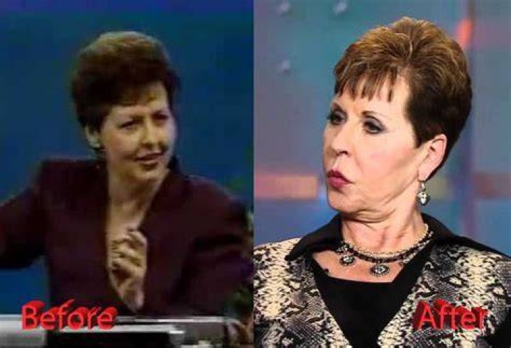 Uncover Joyce Meyer's Transformation: Before And After Plastic Surgery