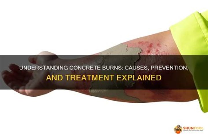 Uncovering The Impact Of Njoku Burns: Causes, Treatment, And Prevention