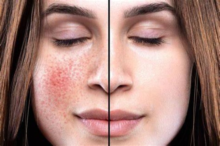 Unveiling The Faces Behind Rosacea: Celebrities' Stories And Surprises