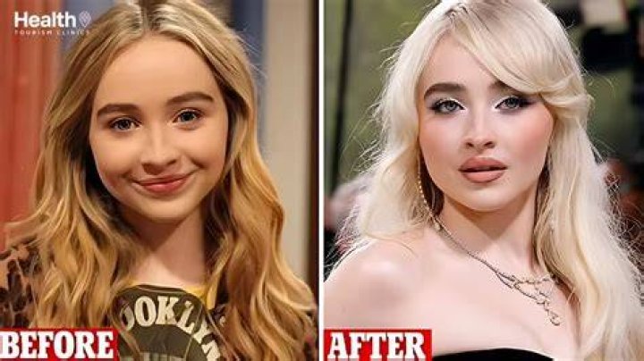 Unveiling The Truth: Has Sabrina Carpenter Gotten Plastic Surgery?