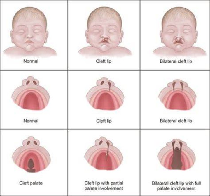 What’s an Orofacial Cleft? Cleft Lip and Cleft Palate Explained GoodRx