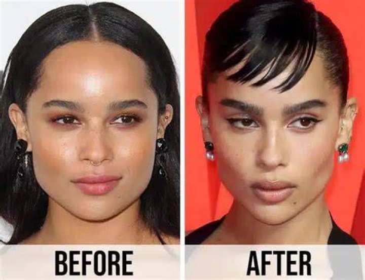 Zoe Kravitz Surgery: Uncovering The Truth Behind The Headlines
